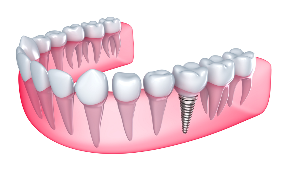 Чем отличаются квалифицированные услуги по имплантации зубов